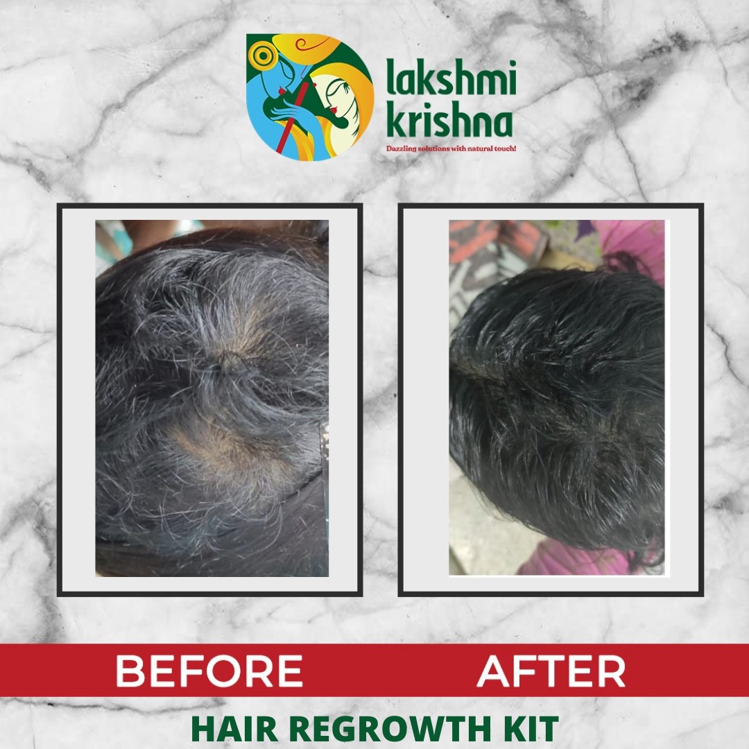 Hair growth kit | Best hair care regrowth combo kit for men and women | LKN