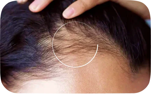 Hair Loss/Hair Growth