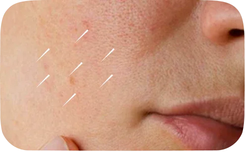 Close-up of cheek with brown age spots and skin pigmentation marks on light skin