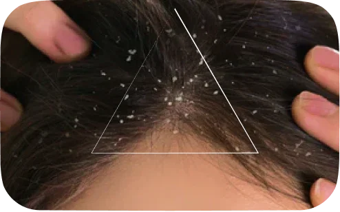 Close-up of scalp with dandruff flakes and hands parting dark hair