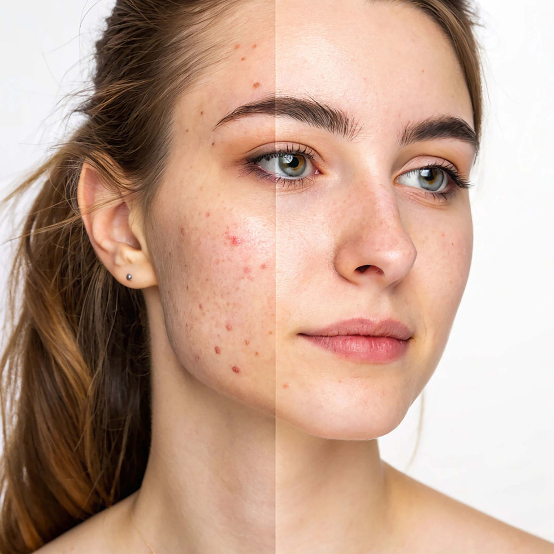 Anti-Pimple
