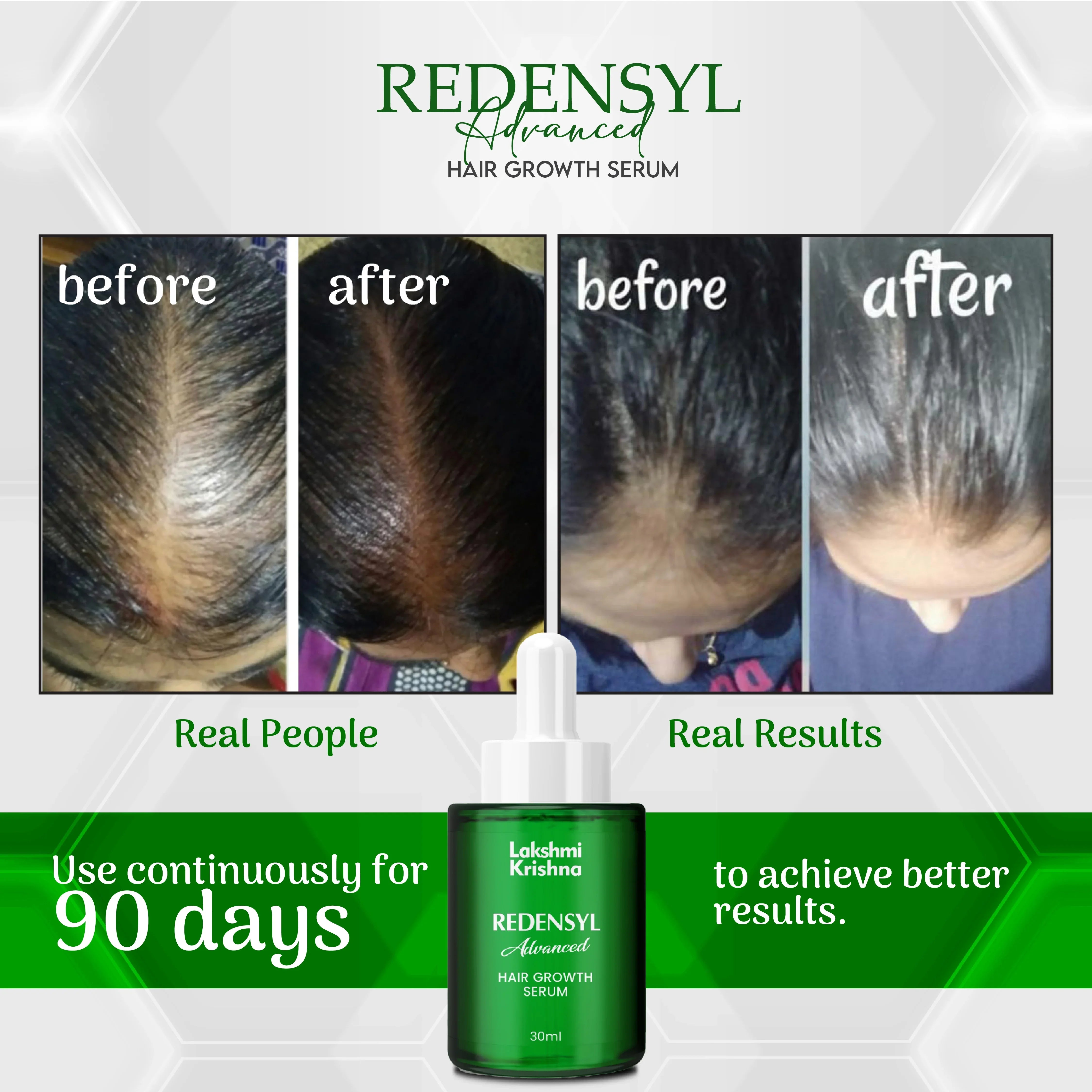 Before and after photos showing hair growth results using Redensyl Advanced hair growth serum over 90 days