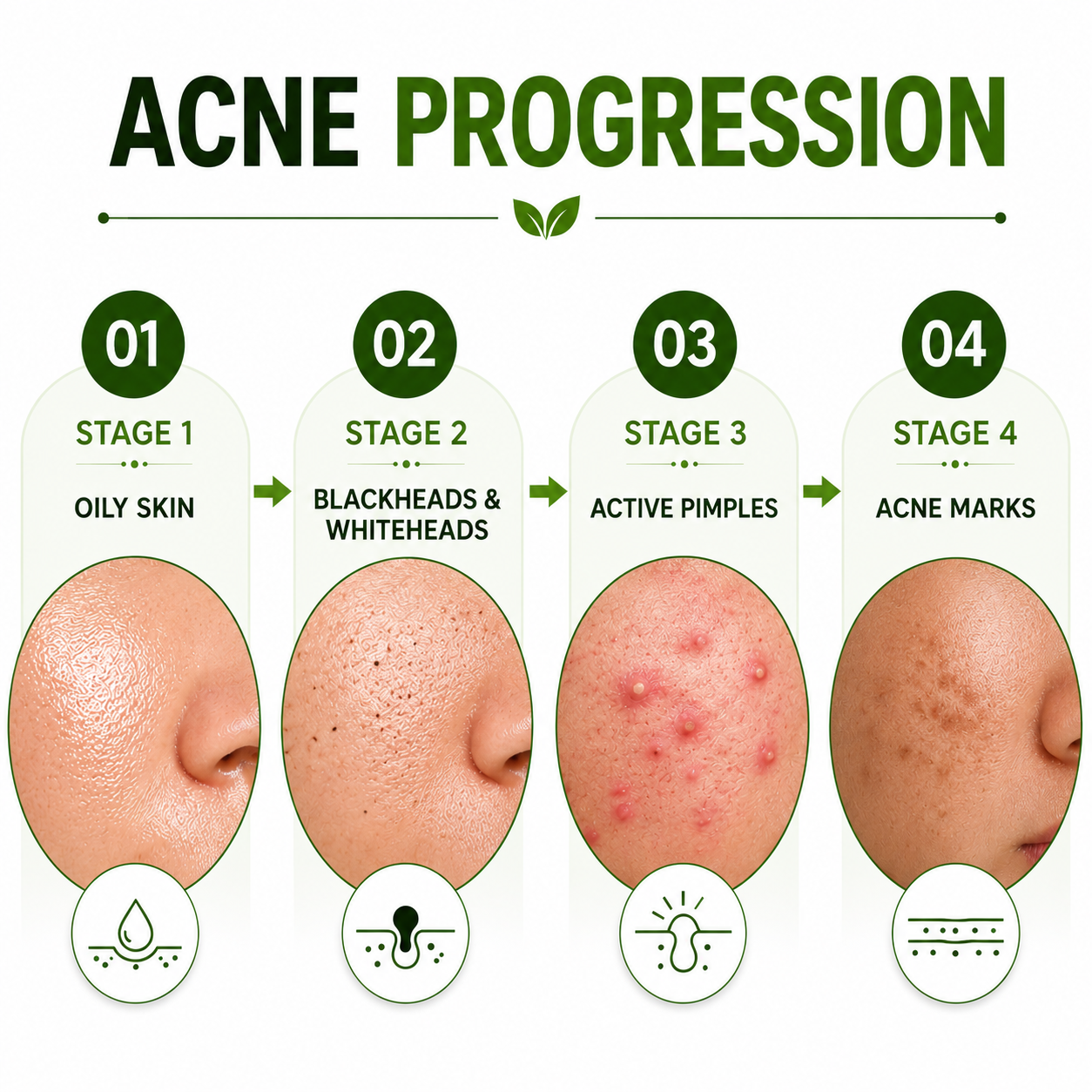 Anti Acne Face Wash